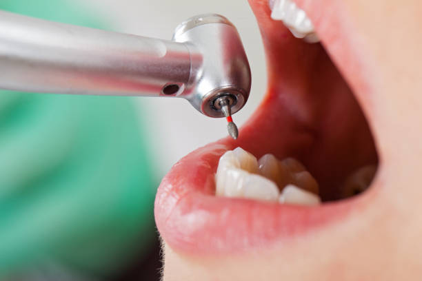 Best Emergency Dentist for Knocked-Out Tooth in Darien, IL